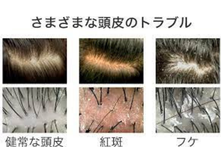 フケじゃない 頭皮から大きい皮膚がむける原因と対処法 ヘアセット ヘアメイクを学ぶなら日本ヘアセットスクール